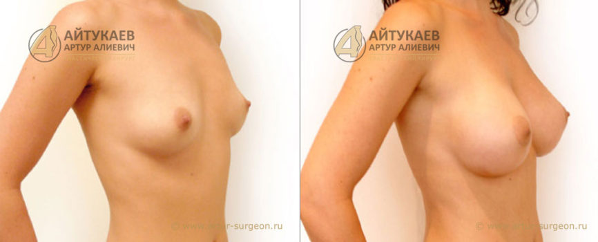 Увеличение груди. Увеличение груди. Пациентка Е. 25 года, анатомические имплантаты.